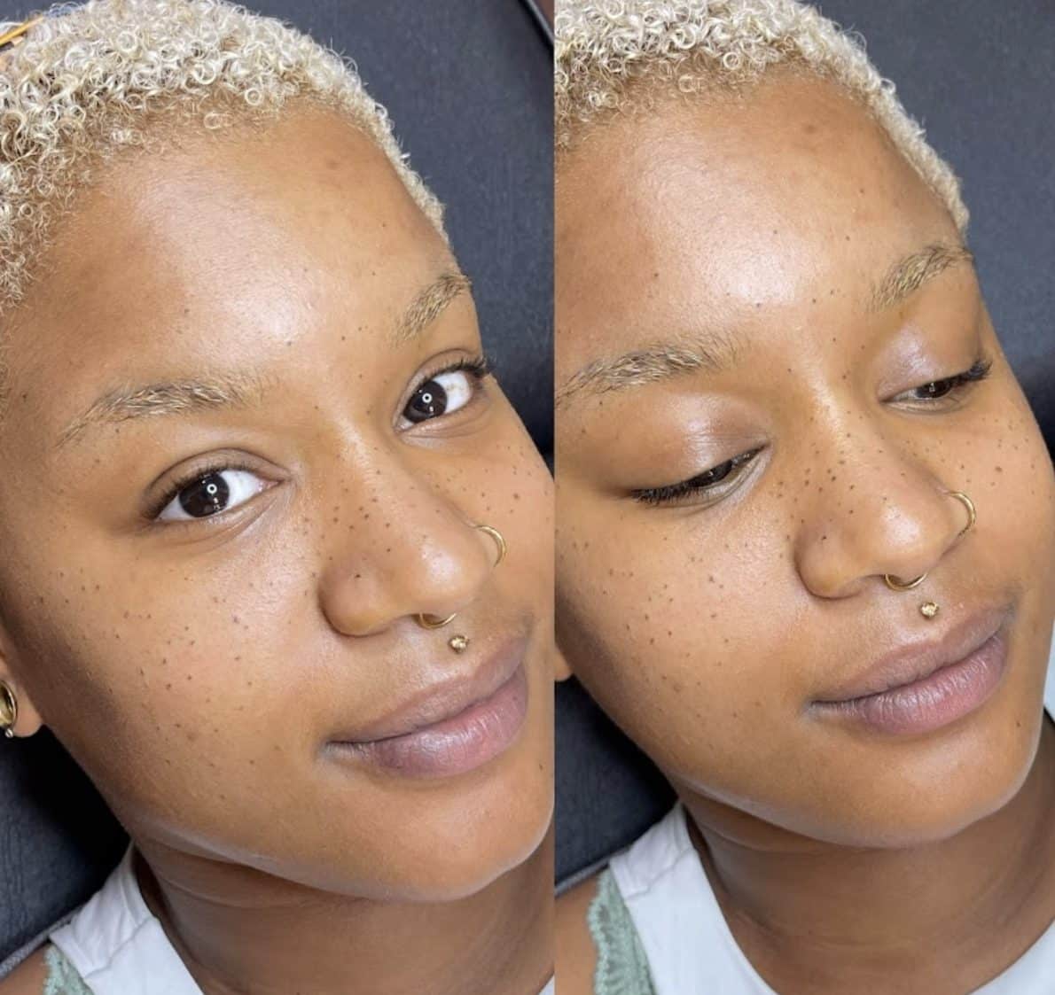 Will you pay to get scars on your face Heres the truth about micro  freckles  Face2Face Africa